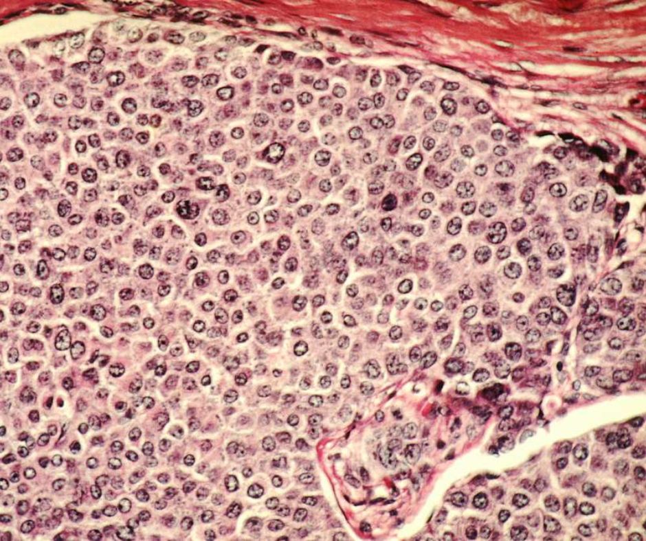 Breast cancer cells